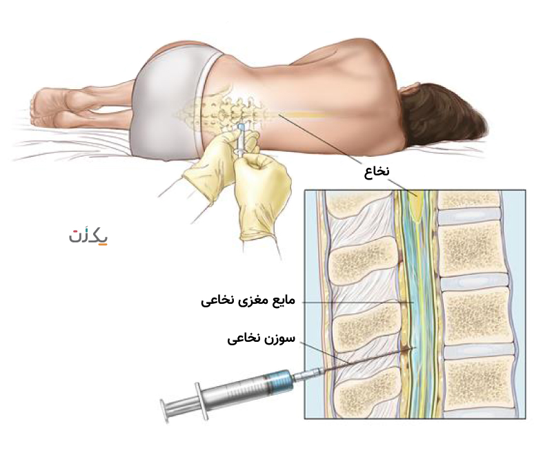 نحوه انجام بی حسی اسپاینال